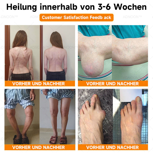 ADNOONâ˘đ¸Botulinum Toxin & Bienenvenom Schmerzlindernde Knochenheilcreme