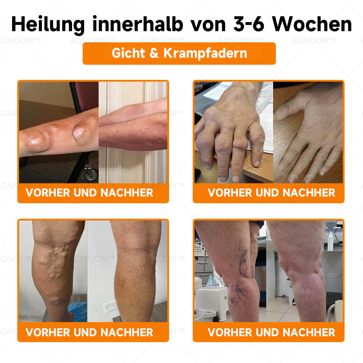 ADNOONâ˘đ¸Botulinum Toxin & Bienenvenom Schmerzlindernde Knochenheilcreme