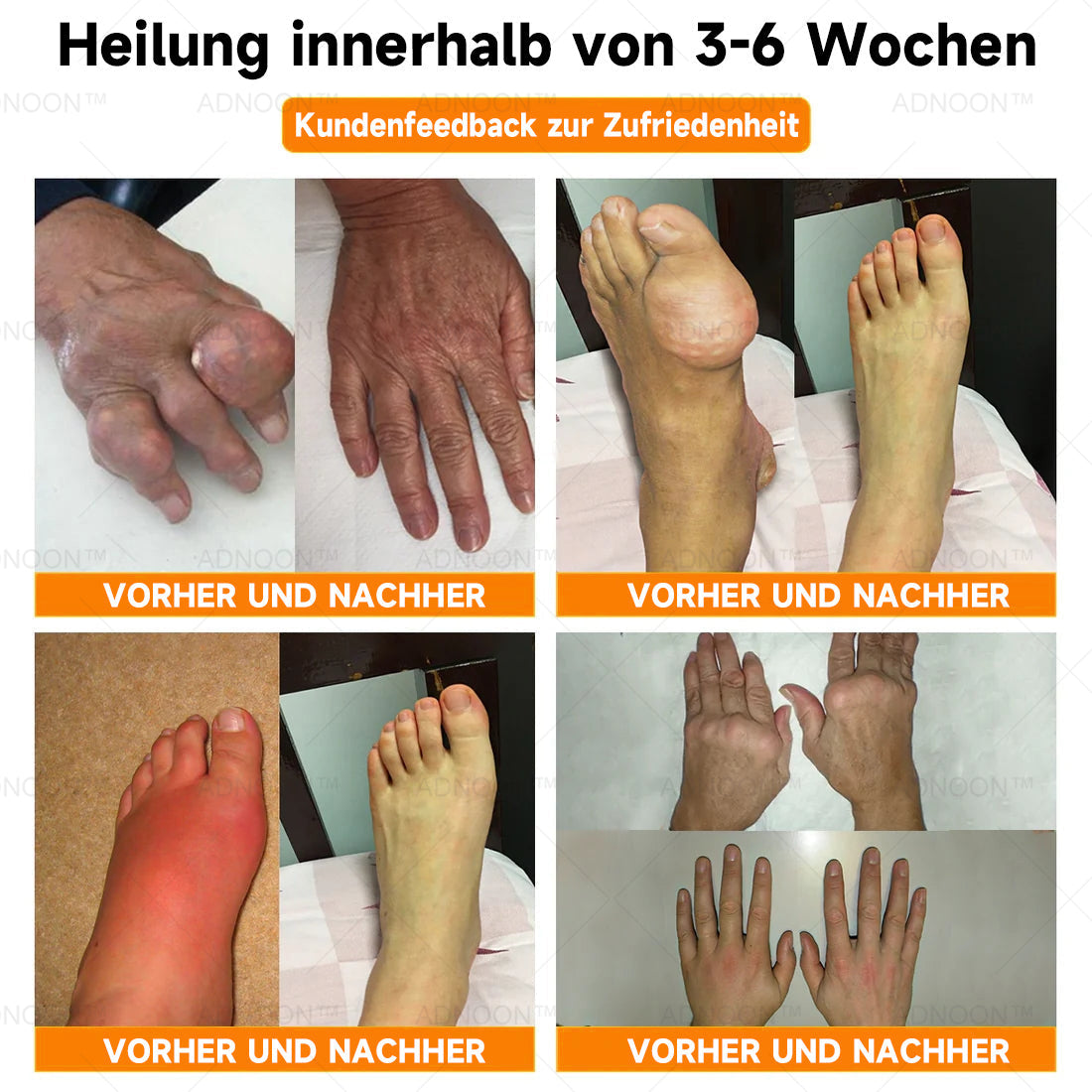 ADNOONâ˘đ¸Botulinum Toxin & Bienenvenom Schmerzlindernde Knochenheilcreme