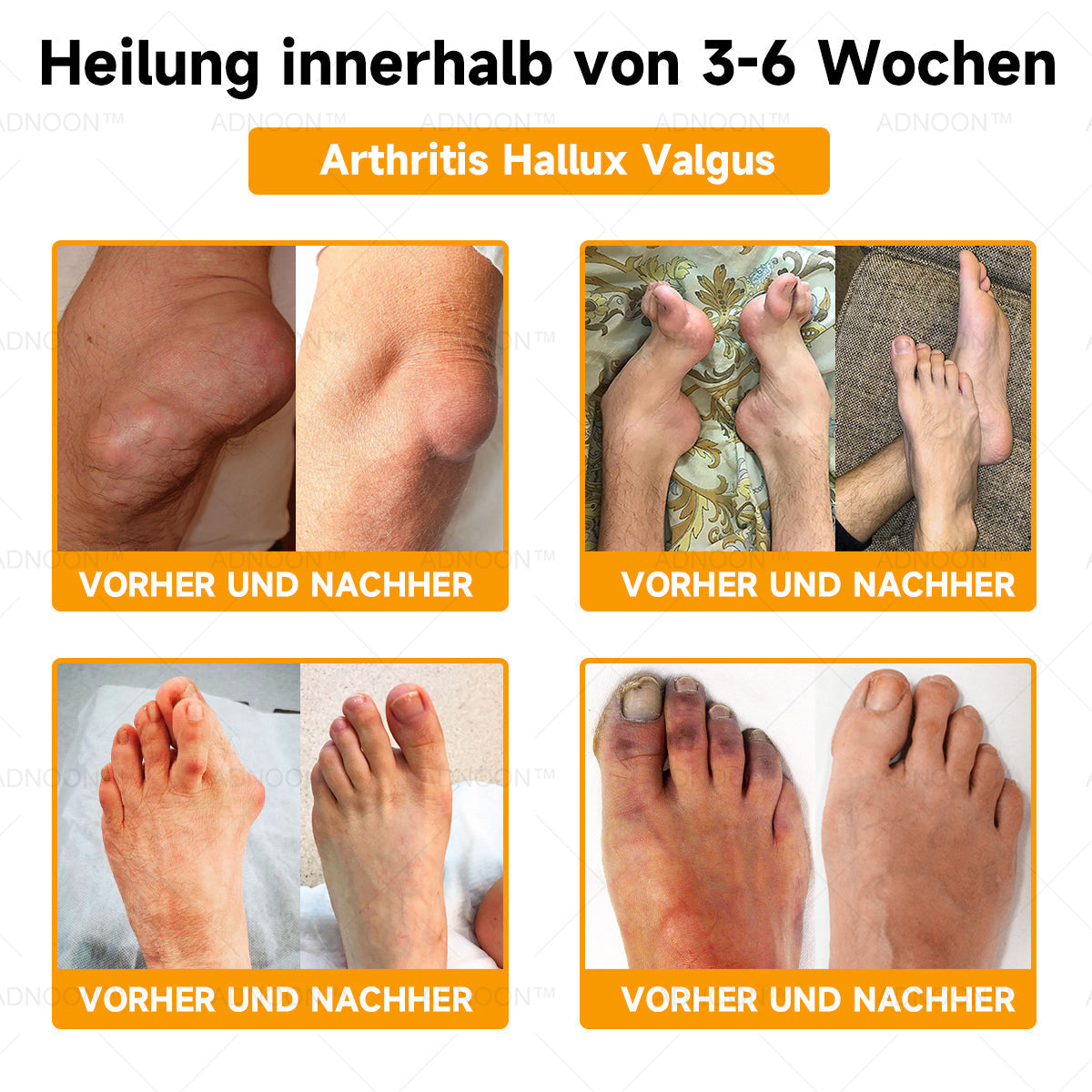 ADNOONâ˘đ¸Botulinum Toxin & Bienenvenom Schmerzlindernde Knochenheilcreme