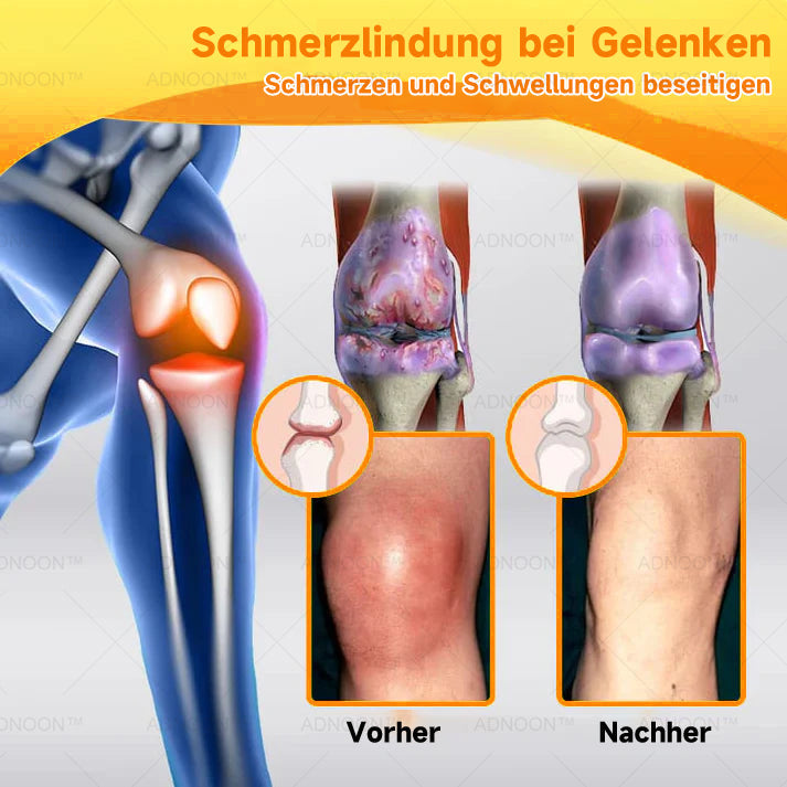 ADNOONâ˘đ¸Botulinum Toxin & Bienenvenom Schmerzlindernde Knochenheilcreme