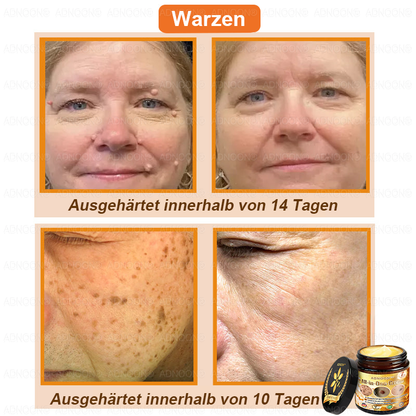 ADNOON®🌻Bienengift All-in-One Pflegecreme—Empfohlen von der DDG 🏅