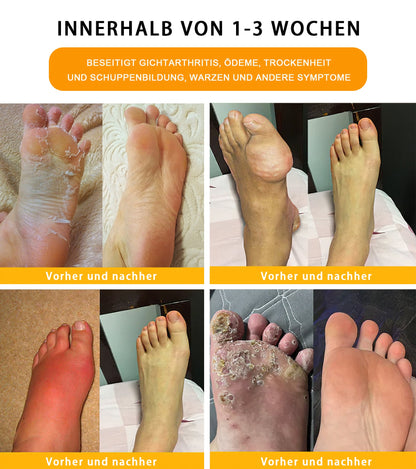 RevivaFoot™🌿🌿Bienenvenom Lymphdrainage- und Schlankheits-Fußbadperlen 70 % RABATT【Arztempfehlung - Bei allen lymphatischen Problemen und Fettleibigkeit】